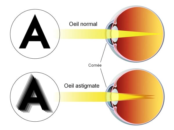 oeil astigmate