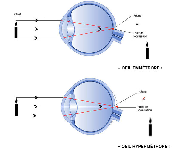 oeil hypermetrope