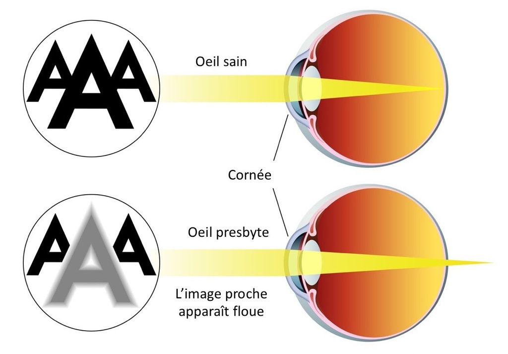 oeil presbytie