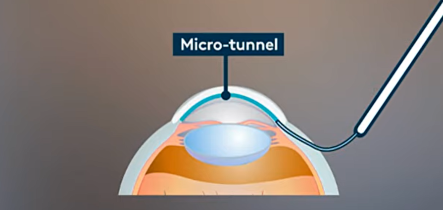 Schéma micro tunnel