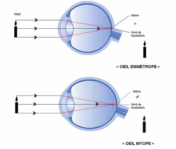 Oeil myope